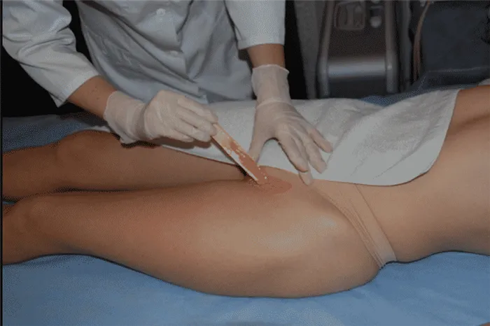 Восковая эпиляция зоны бикини