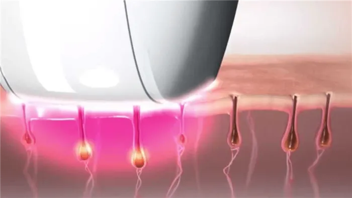 Оптическое удаление волос.